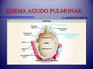 EDEMA AGUDO PULMONAR
CARDIOGENICO
 