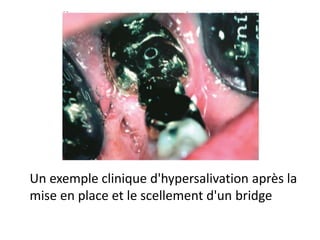 Un exemple clinique d'hypersalivation après la
mise en place et le scellement d'un bridge
 
