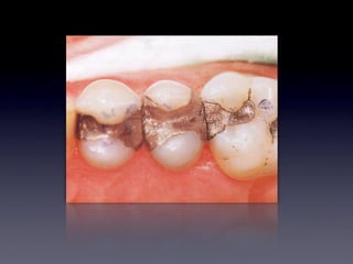 Corrosion Dental