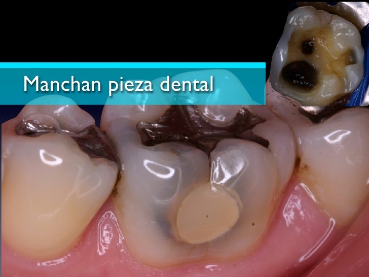 Corrosion Dental
