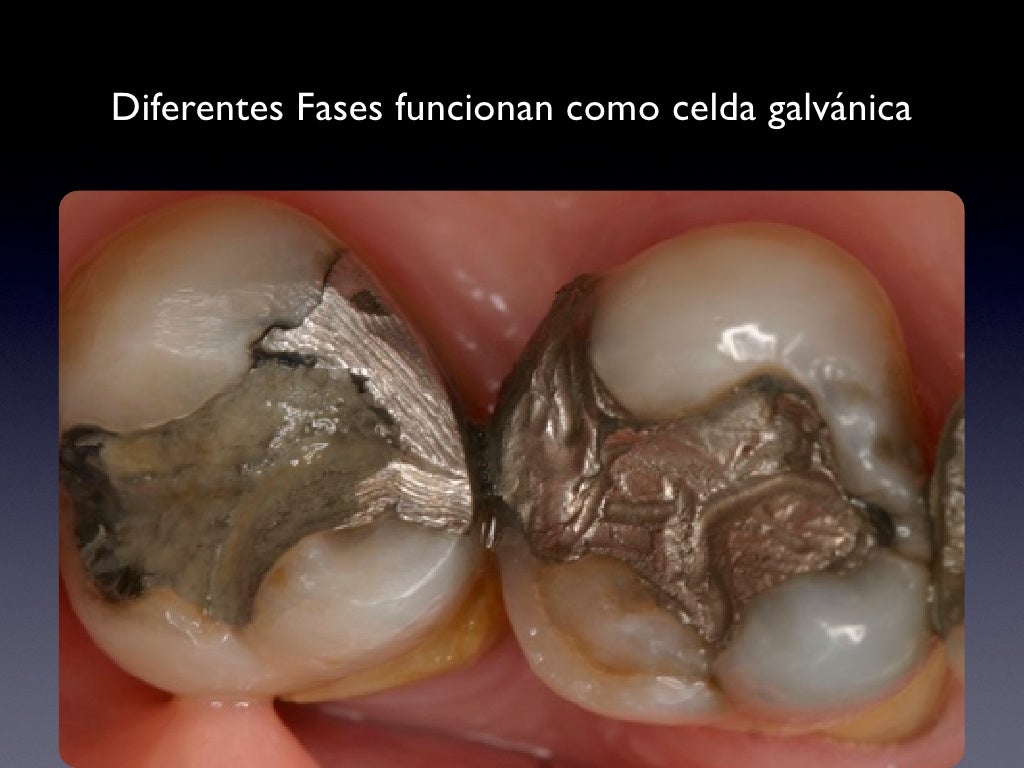 Corrosion Dental