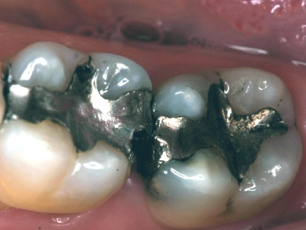 Corrosion Dental