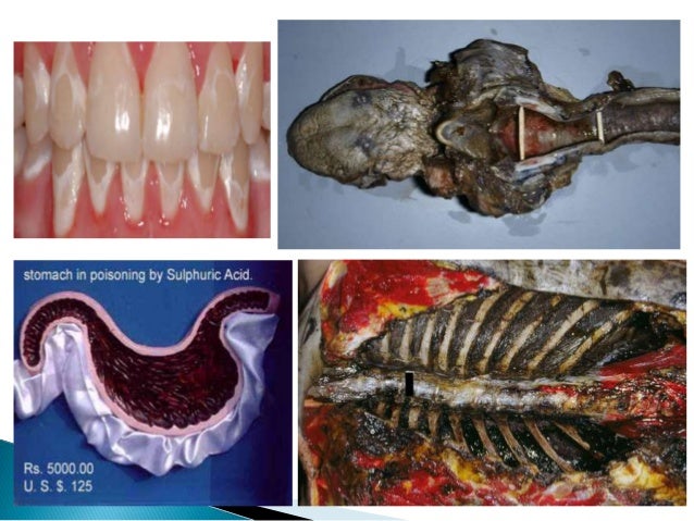 Corrosive Poisons Sulphuric Acid