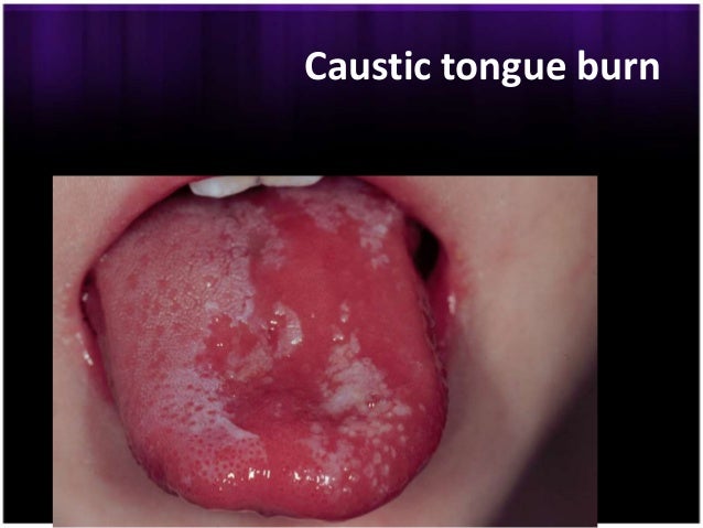 Toxicity of Corrosives