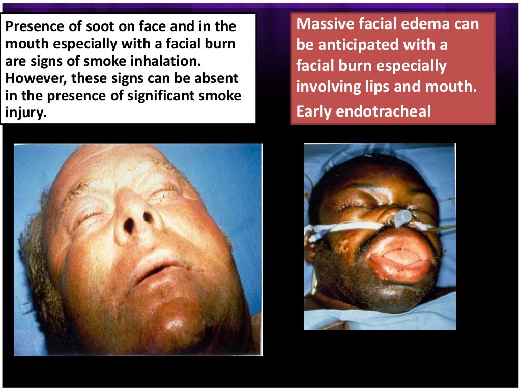 Toxicity of Corrosives