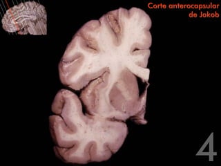 Corte anterocapsular
            de Jakob
 