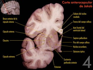 Corte anterocapsular
                                             de Jakob

                                              Cabeza del núcleo
                                              caudado
Brazo anterior de la
cápsula interna                               Tronco del cuerpo calloso

                                              Asta frontal del
Cápsula externa                               ventrículo lateral

                                              Septum pellucidum
Claustro
                                              Pico del cuerpo calloso
                                              Núcleo accumbens
                                              Quiasma óptico
Cápsula extrema
                                  Sustancia
                                  perforada anterior
                       Putamen
 