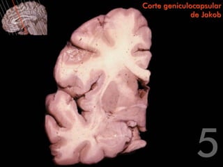 Corte geniculocapsular
              de Jakob
 