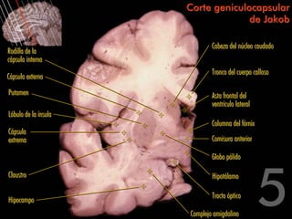 Corte geniculocapsular
                                    de Jakob

                              Cabeza del núcleo caudado
Rodilla de la
cápsula interna
                              Tronco del cuerpo calloso
Cápsula externa
Putamen                       Asta frontal del
                              ventrículo lateral
Lóbulo de la ínsula
                              Columna del fórnix
Cápsula
extrema                       Comisura anterior

                              Globo pálido

Claustro                      Hipotálamo

                              Tracto óptico
Hipocampo
                      Complejo amigdalino
 