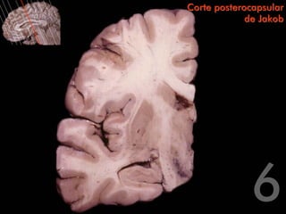 Corte posterocapsular
             de Jakob
 