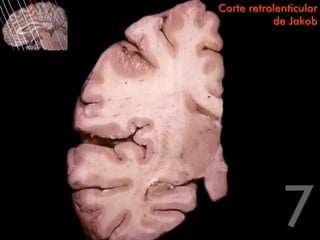 Corte retrolenticular
           de Jakob
 