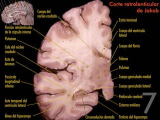 Corte retrolenticular
                          Cuerpo del                                  de Jakob
                          núcleo caudado
                                                                  Estría terminal
Porción retrolenticular
de la cápsula interna                                             Cuerpo del ventrículo
                                                                  lateral
Putamen
Cola del núcleo                                                   Cuerpo del fórnix
caudado
Asta de                                                           Tálamo
Ammon
                                                                  Pulvinar

Fascículo                                                         Cuerpo geniculado medial
longitudinal
inferior                                                          Cuerpo geniculado lateral

                                                                  Pedúnculo cerebral
Asta temporal del
ventrículo lateral                                                Cisterna ambiens

Álveo del hipocampo                        Circunvolución dentada Fimbria del hipocampo
 