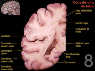 Corte del atrio
                                    de Jakob
                                      Centro oval del lóbulo
                                      parietal


                                      Surco del cíngulo

                                      Circunvolución del
                                      cíngulo
Surco lateral

Circunvolución                        Rodete del cuerpo
temporal superior                     calloso
Surco temporal
superior             Atrio del ventrículo
                     lateral
Circunvolución
temporal media      Surco colateral
Circunvolución
temporal inferior
 