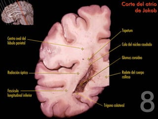 Corte del atrio
                                           de Jakob


                                      Tapetum
Centro oval del
lóbulo parietal                       Cola del núcleo caudado


                                      Glomus coroideo


Radiación óptica                      Rodete del cuerpo
                                      calloso


Fascículo
longitudinal inferior

                        Trígono colateral
 