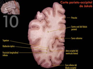 Corte parieto-occipital
                                      de Jakob


                                    Precuña


                                    Centro oval del lóbulo
                                    parietal


                                    Surco calcarino
Tapetum

Radiación óptica
                            Asta occipital del
Fascículo longitudinal      ventrículo lateral
inferior


                            Cara inferior del
                            lóbulo occipital
 