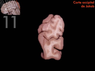 Corte occipital
     de Jakob
 