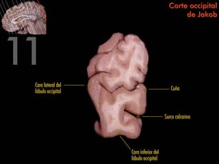 Corte occipital
                                              de Jakob




Cara lateral del
lóbulo occipital                          Cuña



                                       Surco calcarino




                   Cara inferior del
                   lóbulo occipital
 