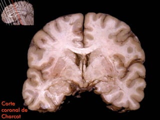 Corte
coronal de
Charcot
 