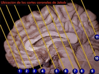 Ubicación de los cortes coronales de Jakob
 
