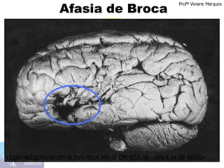Afasia de Broca
Profª Viviane Marques
LESÃO NO GIRO FRONTAL INFERIOR PARTE OPERCULAR – ÁREA 44 DE BROCA
 