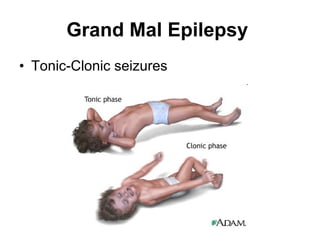 Grand Mal Epilepsy  Tonic-Clonic seizures 