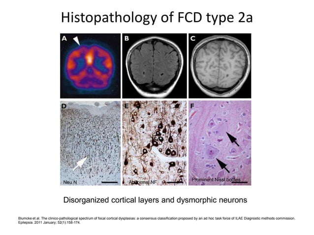Cortical dysplasia | PPTX