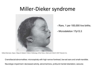 Miller-Dieker syndrome
Lateral view
Superior view
 