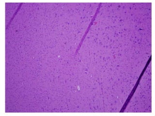 Histopathology of FCD type 1a
Abnormal radial lamination and abundant microcolumns
Blumcke et al. The clinico-pathological...