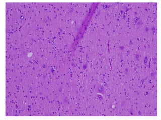 Histopathology of FCD type 2a
Disorganized cortical layers and dysmorphic neurons
Neu N Abnormal NF
Prominent Nissl bodies...