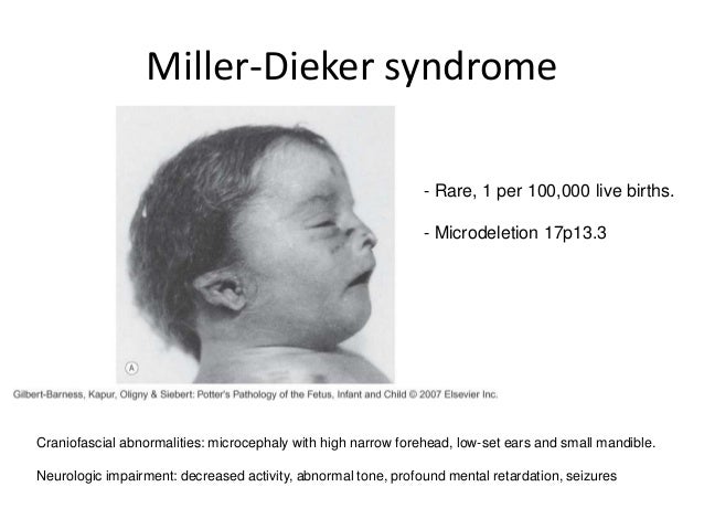 Celebrities with Russell Silver Syndrome