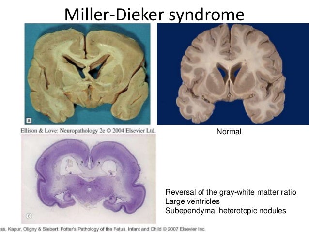 Cortical dysplasia