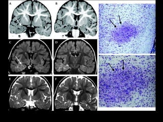 Cortical dysplasia and epilepsy | PPTX