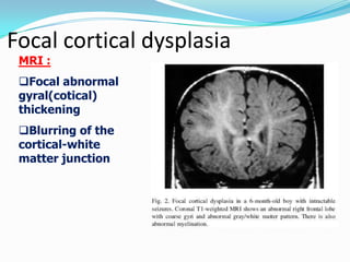 Cortical dysplasia; other clinical presentations
 Dysplasia involving extratemporal regions
demonstrates earlier age at p...