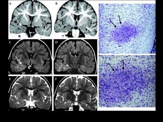 5-year-old boy with refractory epilepsy. Coronal T2WI
imaging done on 1.5 T MR scanner was read as normal.
Imaging done at...