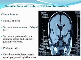 Lissencephaly with sub cortical band heterotopia.
Clinical features
 Normal at birth.
 Seizures uncommon on 1st day of
l...