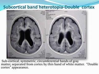 Subcortical band heterotopia-Double cortex
Sub-cortical, symmetric, circumferential bands of gray
matter, separated from c...