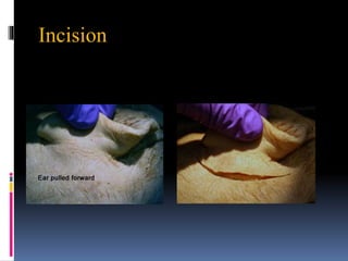 Incision
 
