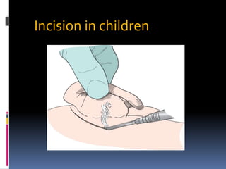 Incision in children
 