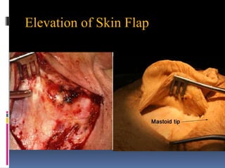 Elevation of Skin Flap
 