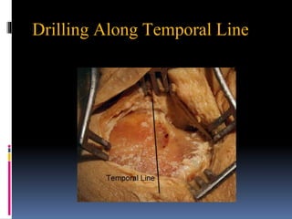 Drilling Along Temporal Line
 