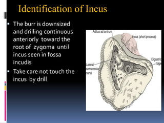 Identification of Incus
 The burr is downsized
and drilling continuous
anteriorly toward the
root of zygoma until
incus seen in fossa
incudis
 Take care not touch the
incus by drill
 