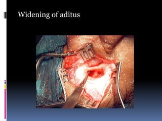 Widening of aditus
 