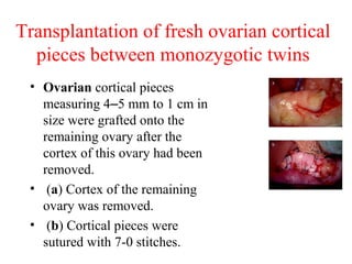 Transplantation of fresh ovarian cortical
pieces between monozygotic twins
• Ovarian cortical pieces
measuring 4–5 mm to 1 cm in
size were grafted onto the
remaining ovary after the
cortex of this ovary had been
removed.
• (a) Cortex of the remaining
ovary was removed.
• (b) Cortical pieces were
sutured with 7-0 stitches.
 