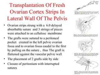 Transplantation Of Fresh
Ovarian Cortex Strips In
Lateral Wall Of The Pelvis
• Ovarian strips strung with a 6.0 delayed
absorbable suture and 3 strings of pieces
were attached to an cellulose membrane
• The grafts were sutured to a peritoneal
pocket created in the left pelvic ovarian
fossa and to ovarian fossa caudal to the first
by pulling on the suture , thus The graft is
flattened against the vascular pelvic wall
• The placement of 2 grafts side by side
• Closure of peritonium with interrupted
sutures
 