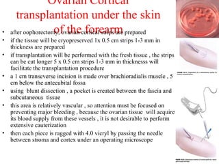 Ovarian Cortical
transplantation under the skin
of the forearm• after oophorectomy, ovarian cortical strips are prepared
• if the tissue will be cryopreserved 1x 0.5 cm strips 1-3 mm in
thickness are prepared
• if transplantation will be performed with the fresh tissue , the strips
can be cut longer 5 x 0.5 cm strips 1-3 mm in thicknesss will
facilitate the transplantation procedure
• a 1 cm transeverse incision is made over brachioradialis muscle , 5
cm below the antecubital fossa
• using blunt dissection , a pocket is created between the fascia and
subcutaneous tissue
• this area is relatively vascular , so attention must be focused on
preventing major bleeding , because the ovarian tissue will acquire
its blood supply from these vessels , it is not desirable to perform
extensive cauterization
• then each piece is ragged with 4.0 vicryl by passing the needle
between stroma and cortex under an operating microscope
 