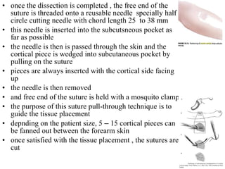 • once the dissection is completed , the free end of the
suture is threaded onto a reusable needle specially half
circle cutting needle with chord length 25 to 38 mm
• this needle is inserted into the subcutsneous pocket as
far as possible
• the needle is then is passed through the skin and the
cortical piece is wedged into subcutaneous pocket by
pulling on the suture
• pieces are always inserted with the cortical side facing
up
• the needle is then removed
• and free end of the suture is held with a mosquito clamp
• the purpose of this suture pull-through technique is to
guide the tissue placement
• depnding on the patient size, 5 – 15 cortical pieces can
be fanned out between the forearm skin
• once satisfied with the tissue placement , the sutures are
cut
 