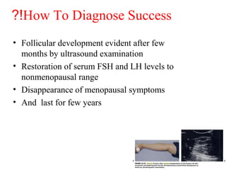 How To Diagnose Success?!
• Follicular development evident after few
months by ultrasound examination
• Restoration of serum FSH and LH levels to
nonmenopausal range
• Disappearance of menopausal symptoms
• And last for few years
 