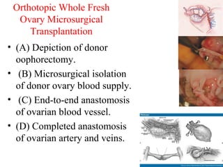 Orthotopic Whole Fresh
Ovary Microsurgical
Transplantation
• (A) Depiction of donor
oophorectomy.
• (B) Microsurgical isolation
of donor ovary blood supply.
• (C) End-to-end anastomosis
of ovarian blood vessel.
• (D) Completed anastomosis
of ovarian artery and veins.
 