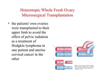 Heterotopic Whole Fresh Ovary
Microsurgical Transplantation
• the patients' own ovaries
were transplanted to their
upper limb to avoid the
effect of pelvic radiation
as a treatment of
Hodgkin lymphoma in
one patient and uterine
cervical cancer in the
other
 