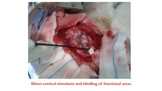 Direct cortical stimulator and labelling of functional areas.
 